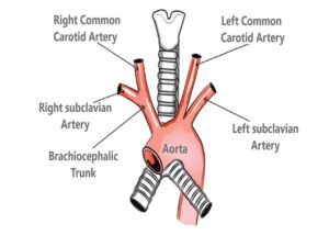 Aberrant Subclavian Artery
