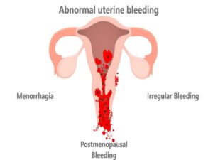 Abnormal uterine bleeding