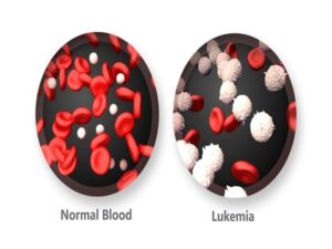 Acute Promyelocytic Leukemia