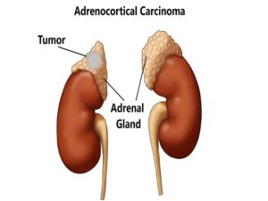 Adrenocortical Carcinoma