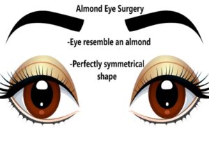 Almond Eye Surgery