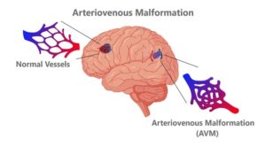 Arteriovenous Malformation Avm