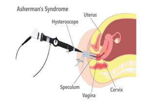 Asherman syndrome