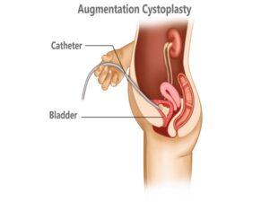 Augmentation Cystoplasty