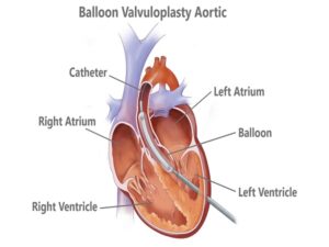 Balloon Valvuloplasty Aortic