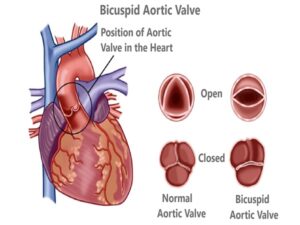 Bicuspid Aortic Valve