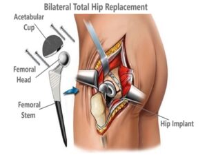 Bilateral Total Hip Replacement