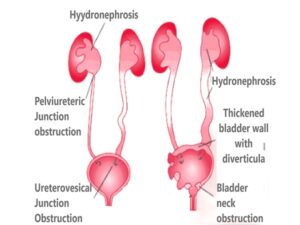 Bladder Exstrophy And Epispadias