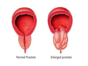 Bladder Outlet Obstruction