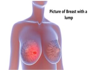 Breast Lumpectomy