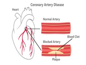 Coronary Artery Disease