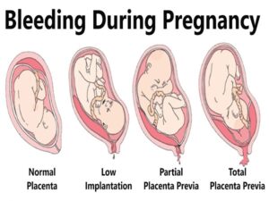 Bleeding during Pregnancy