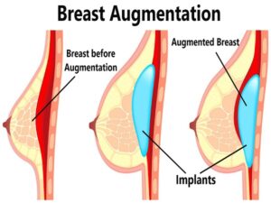 Breast Augmentation