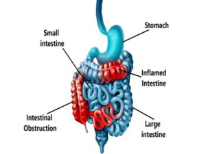Chronic Intestinal Pseudo Obstruction Cip Treatment