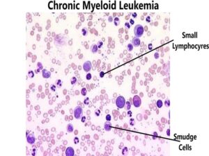 Chronic Myeloid Leukemia