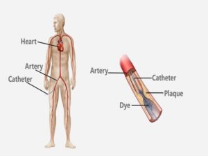 Coronary Angiography Test in India