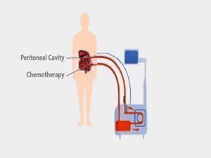 HIPEC Treatment Cost in India