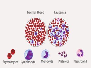 Leukemia Treatment