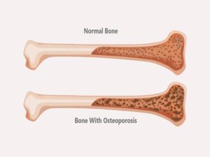 Osteoporosis Treatment Cost in India