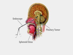 Pituitary Tumor Treatment In India
