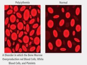 Polycythemia Vera Treatment In india