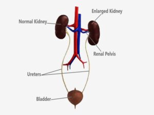 Pyeloplasty Cost In India