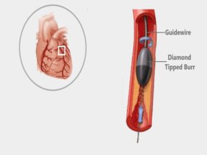 Rotational Angioplasty Cost in India