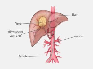 TARE Procedure Cost in India
