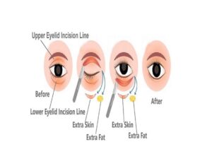 Blepharoplasty Cost in India