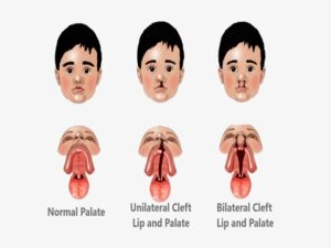 Cleft Lip and Palate Surgery Cost in India