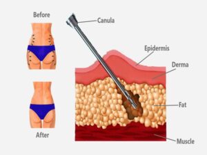 Liposuction Sugery Cost in India