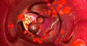 Aplastic-Anemia-Treated