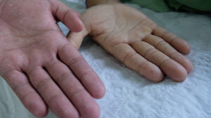 Aplastic