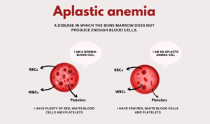 Aplastic anaemia